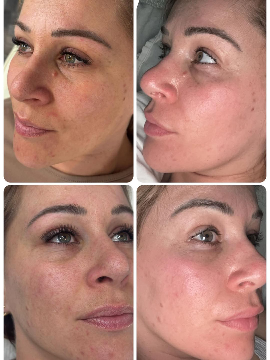 Before and after microneedling treatment at TLC Maidstone