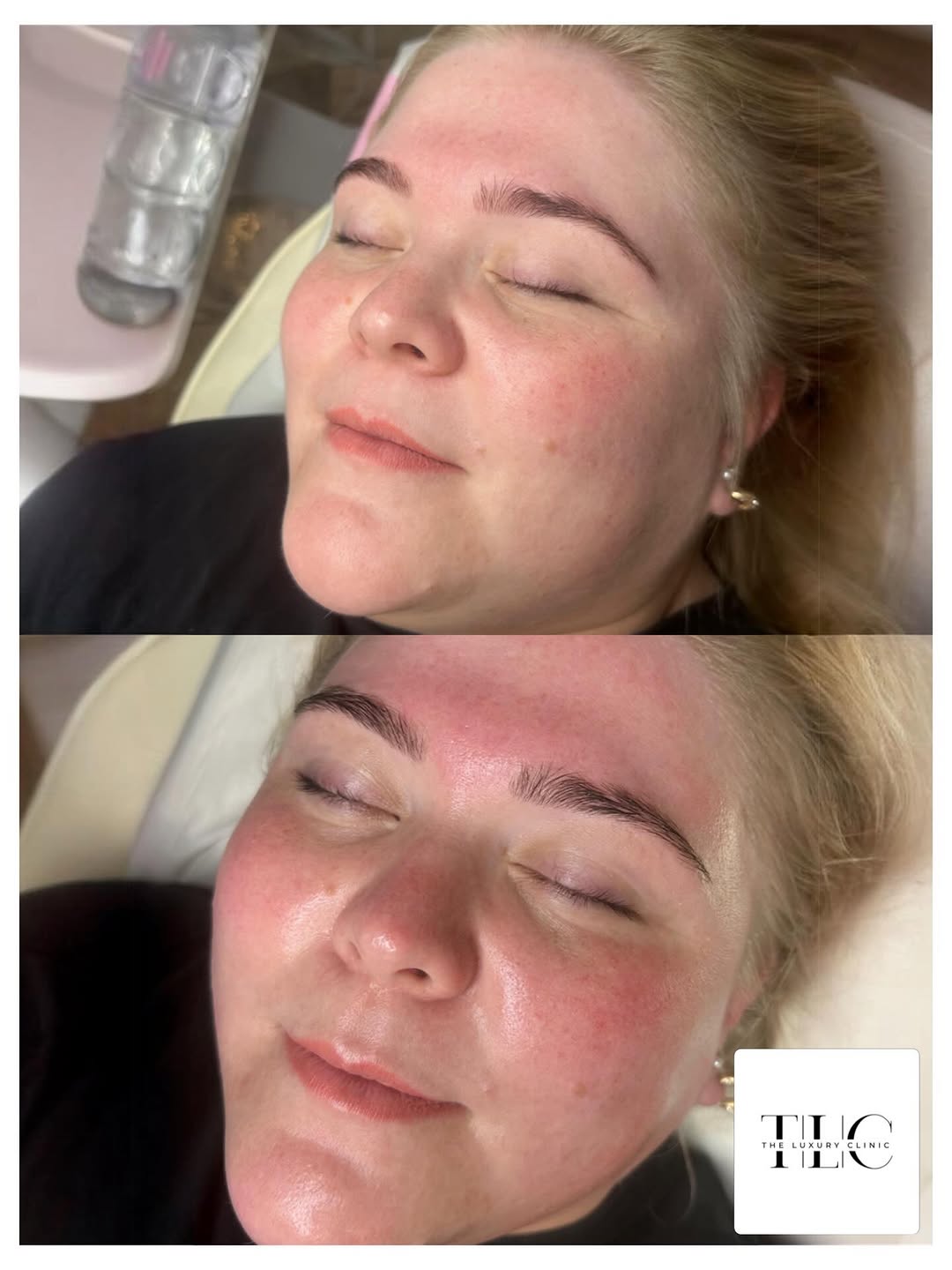 Client after hydrofacial treatment at TLC Maidstone